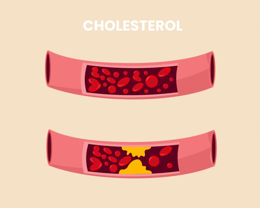 cholesterol